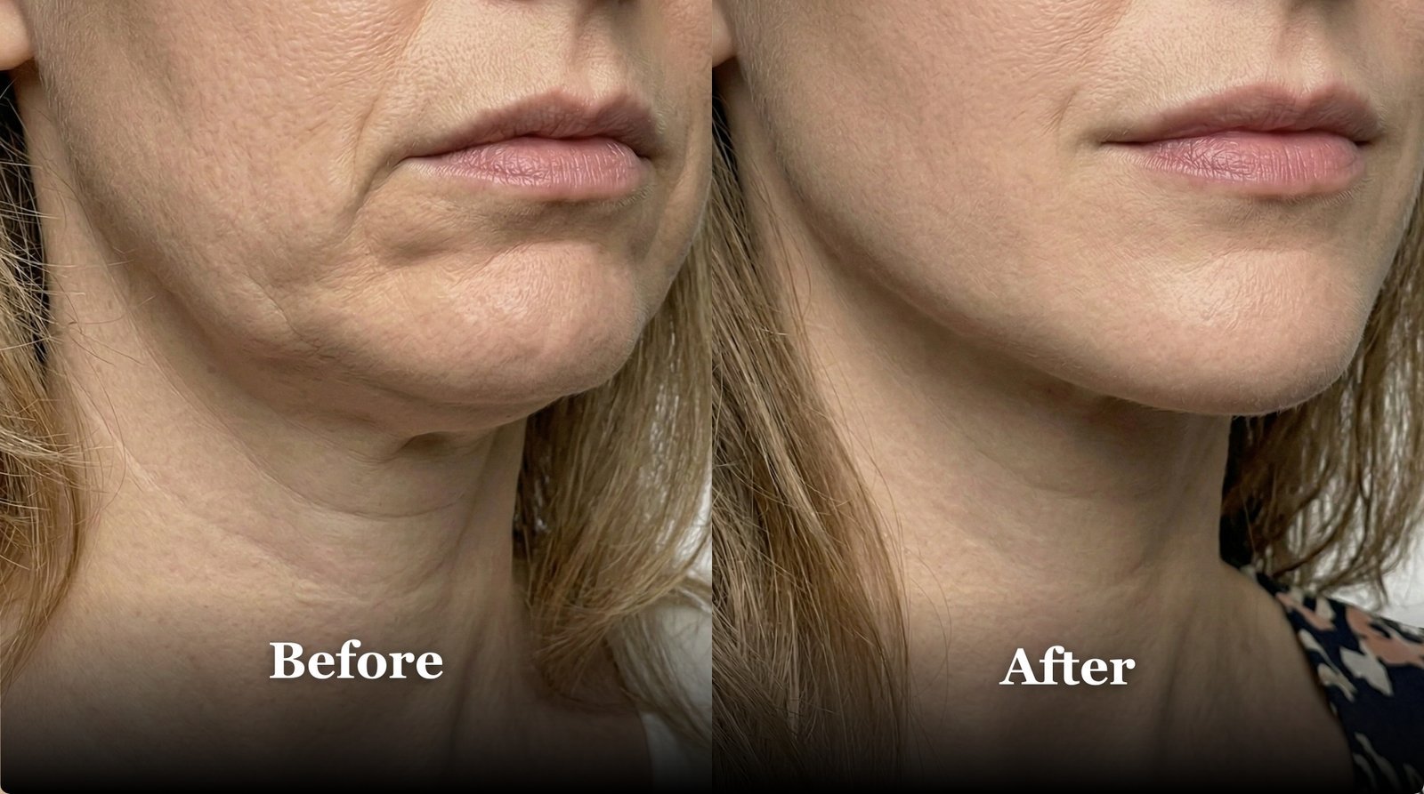 Lower-Face Lift