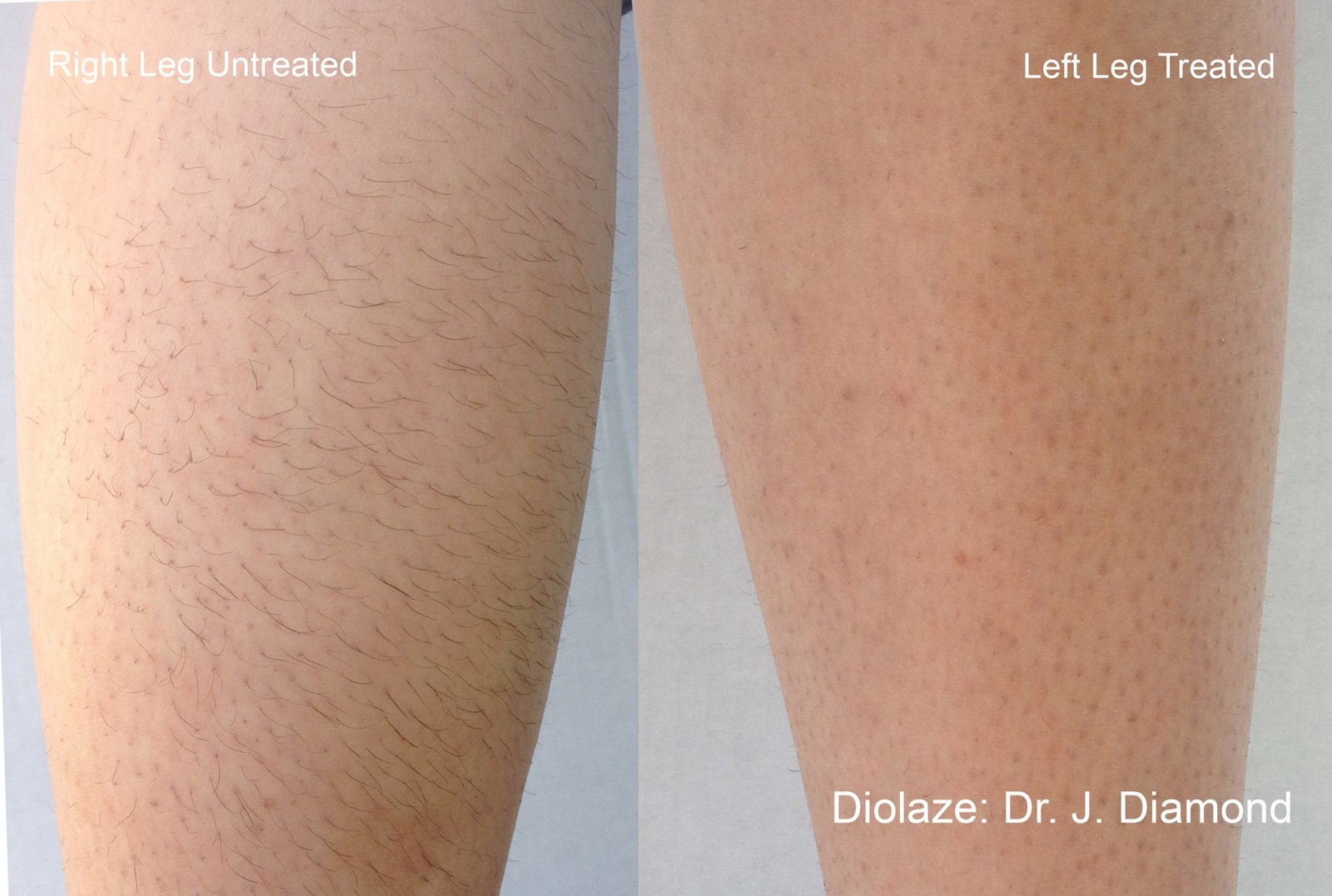 Diolaze XL Max before and after leg comparison