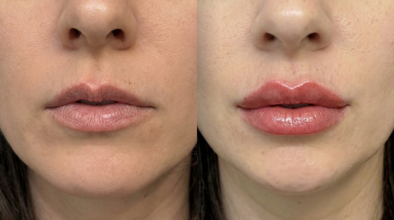 Lip Filler treatment planning