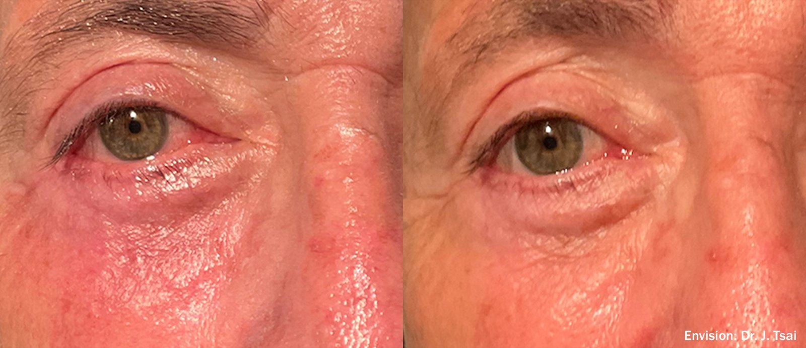 Lumecca IPL before and after eye area redness comparison