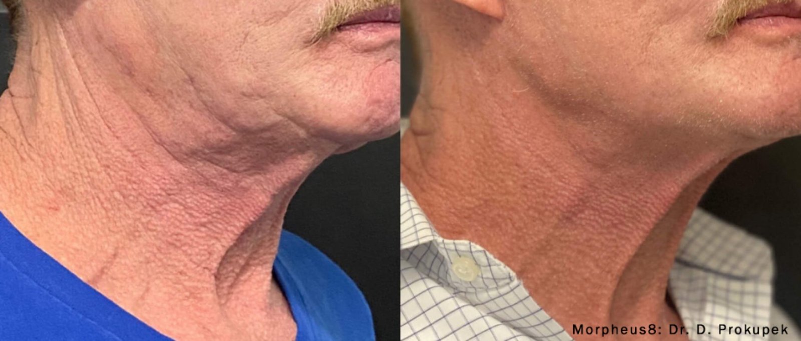 Morpheus8 before and after skin tightening comparison