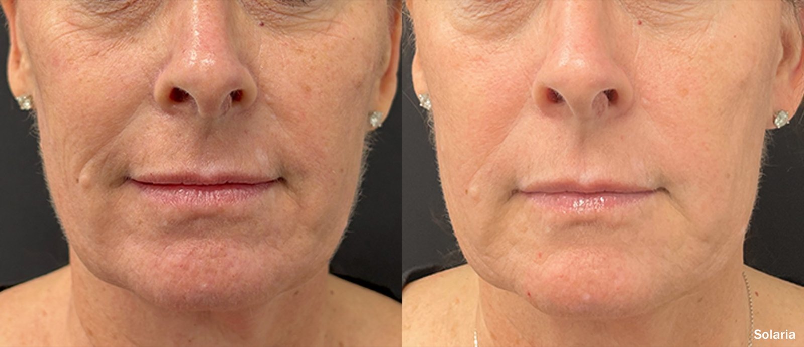 Solaria CO2 Laser before and after side profile comparison
